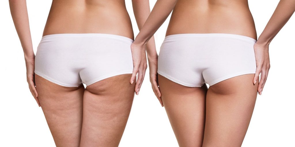 Skin Tightening and Anti-Cellulite Treatment Montreal