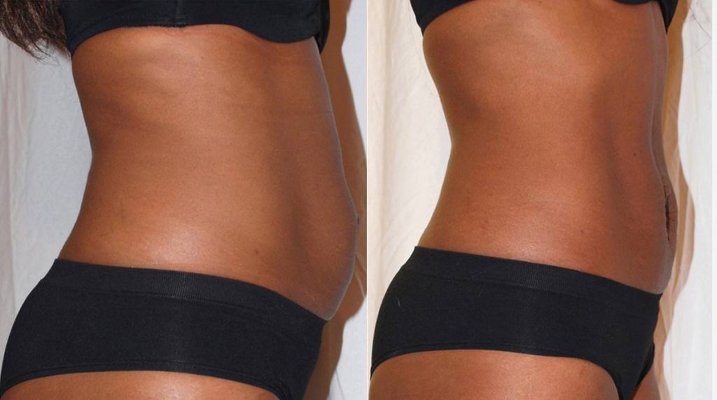 spa montreal body contouring spa montreal lipo cavitation body contouring treatment before after client 1