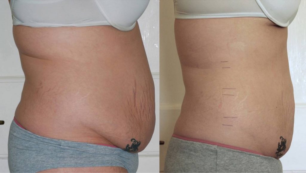 spa montreal body contouring spa montreal lipo cavitation body contouring treatment before after client 3