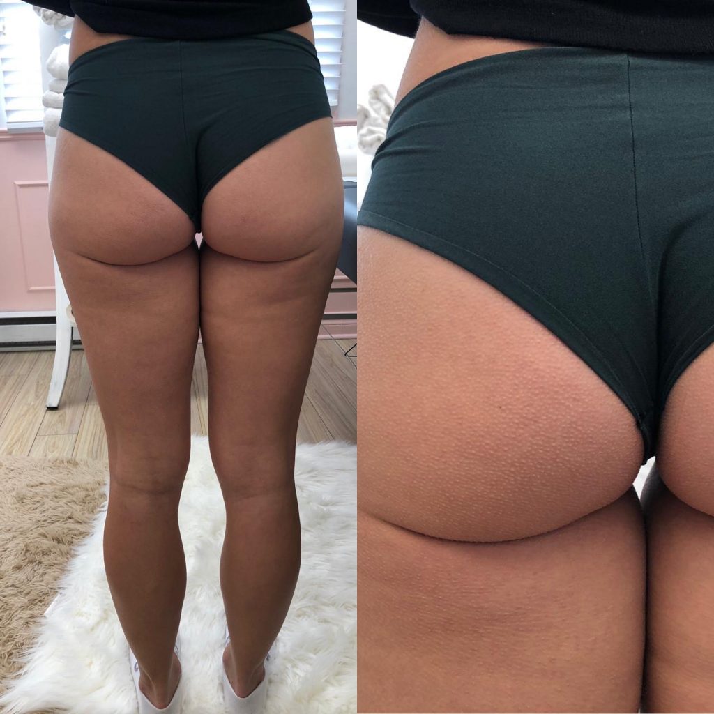 Brazilian Butt Lift Montreal customer