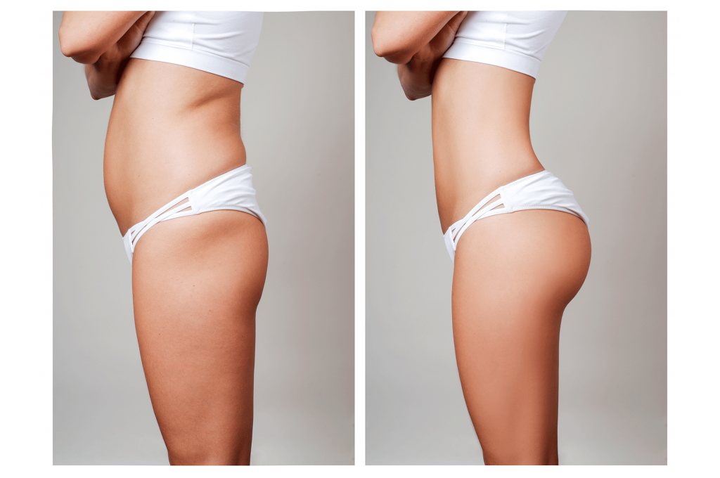 body contouring spa montreal brazilian butt lift Montreal before and after