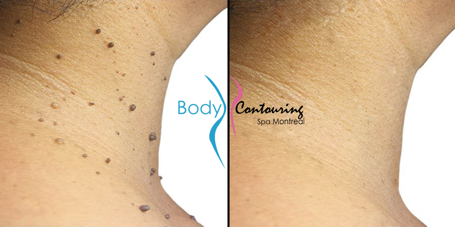 spa montreal body contouring spa montreal skin tag remove customer before and after