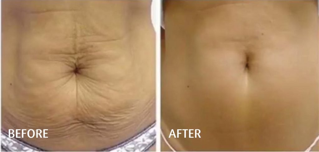 body contouring spa montreal RF belly Skin tightening