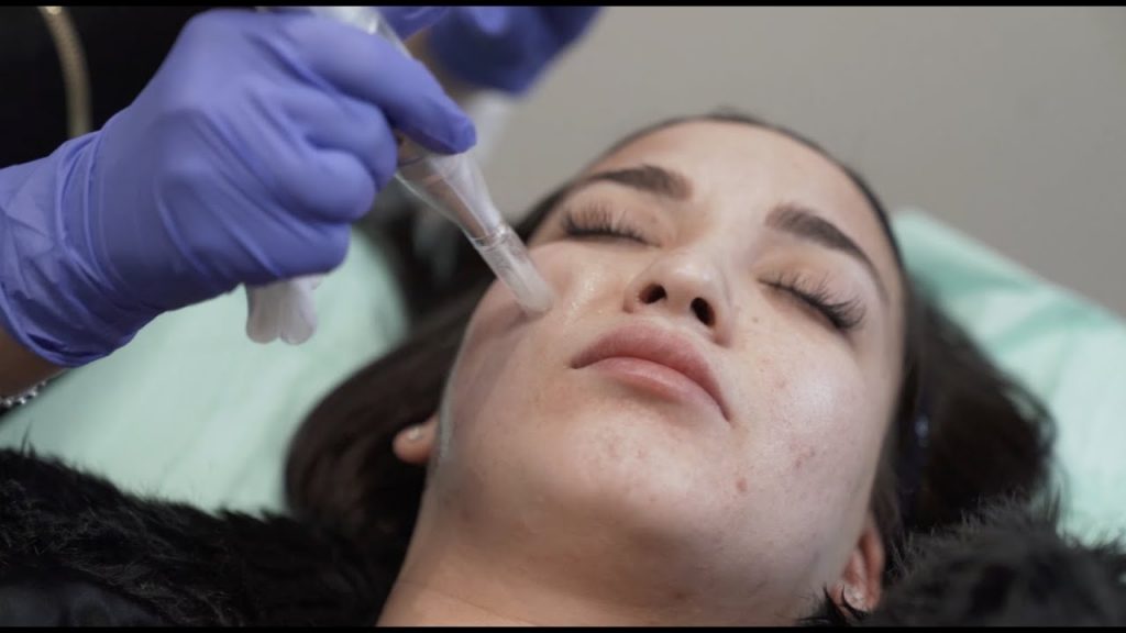 microneedling body contouring spa montreal technician using dermapen on customer face 4